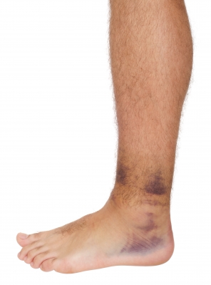 Illustration for article titled What are Some Different Types of Venous Diseases?